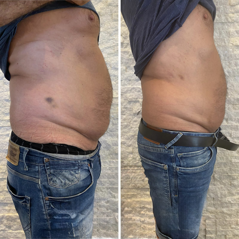 EMShape X Vorher-Nachher: Bauch und Taille seitlich