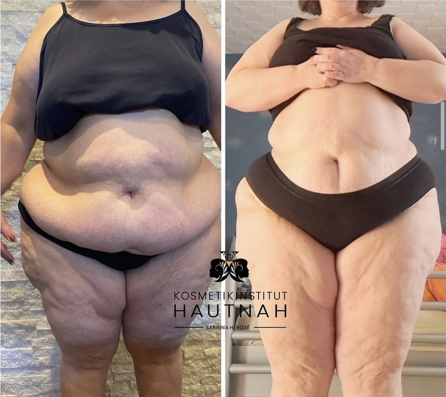 EMShape X Vorher-Nachher: Bauch und Beine von vorne