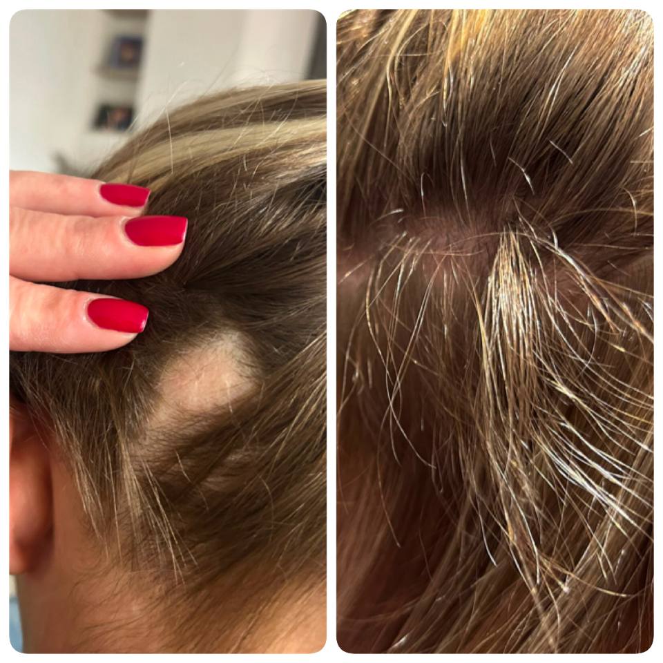 Haarkonzept – Vorher-Nachher an der Schläfe, nachgewachsenes Haar