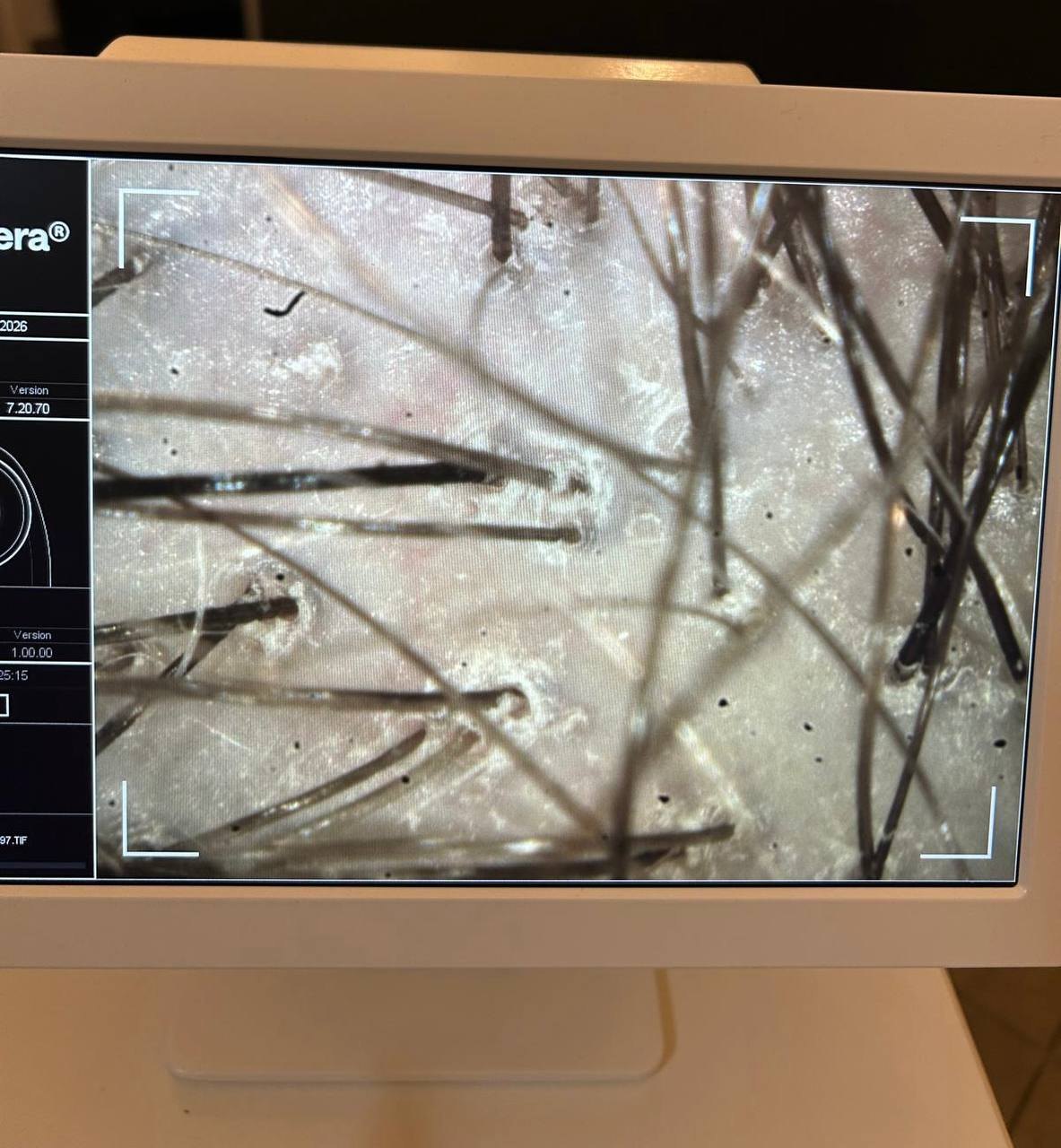 Haarstruktur in starker Vergr&ouml;&szlig;erung auf dem Bildschirm der Microkamera
