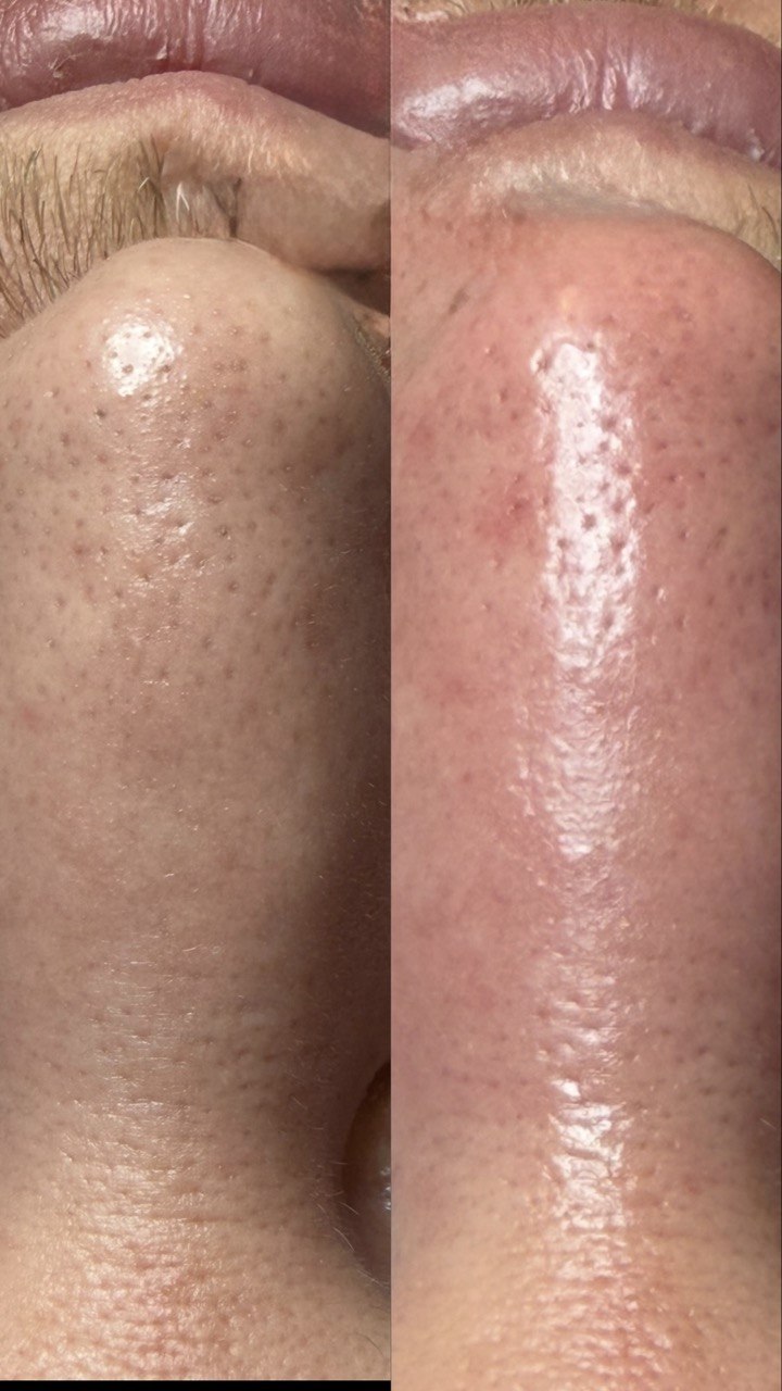 Hydrafacial&reg; &ndash; Vorher-Nachher, Beispiel 1