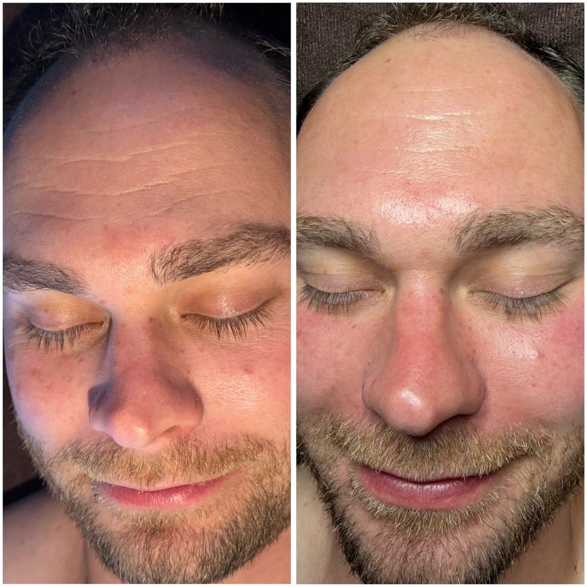 Hydrafacial&reg; &ndash; Vorher-Nachher, Beispiel 2