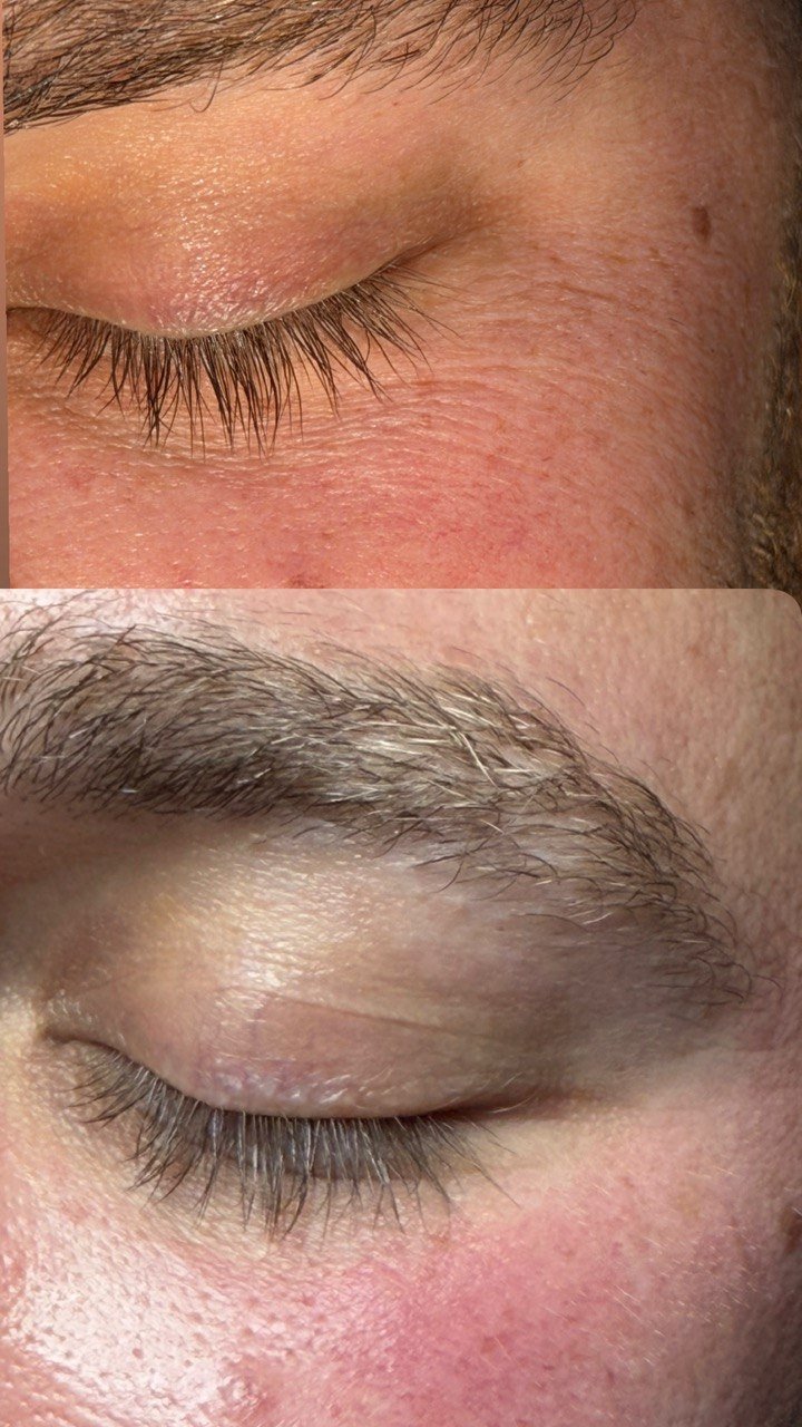 Hydrafacial&reg; &ndash; Vorher-Nachher, Beispiel 3
