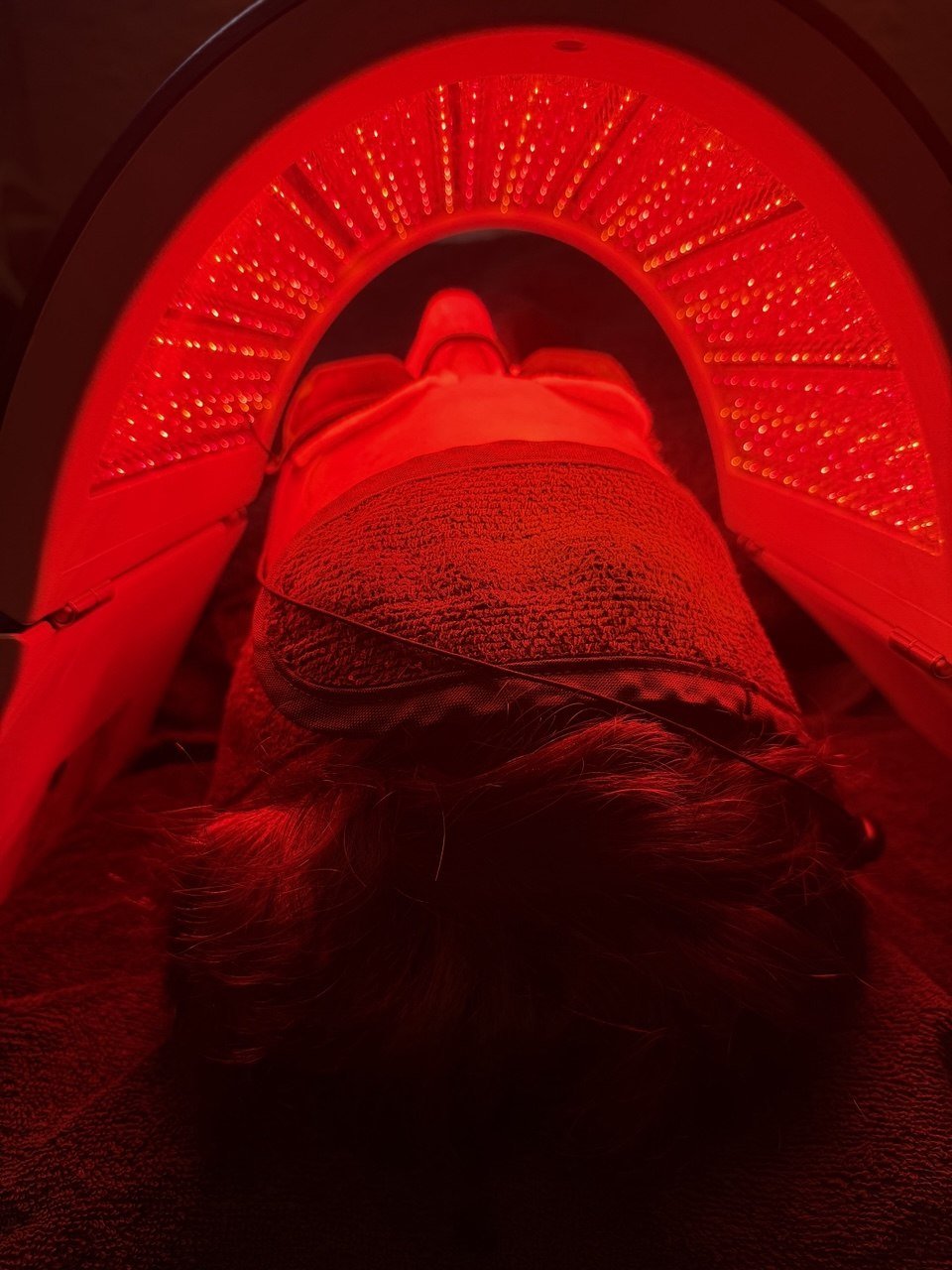 Hydrafacial&reg; &ndash; Vorher-Nachher, Beispiel 4